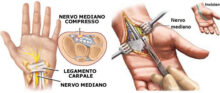 Sindrome del tunnel carpale: sintomi e approccio chirurgico